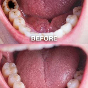 Mrypek® DenPerm Cavity-Repair Natural Enamel Filling Gel - Image 5